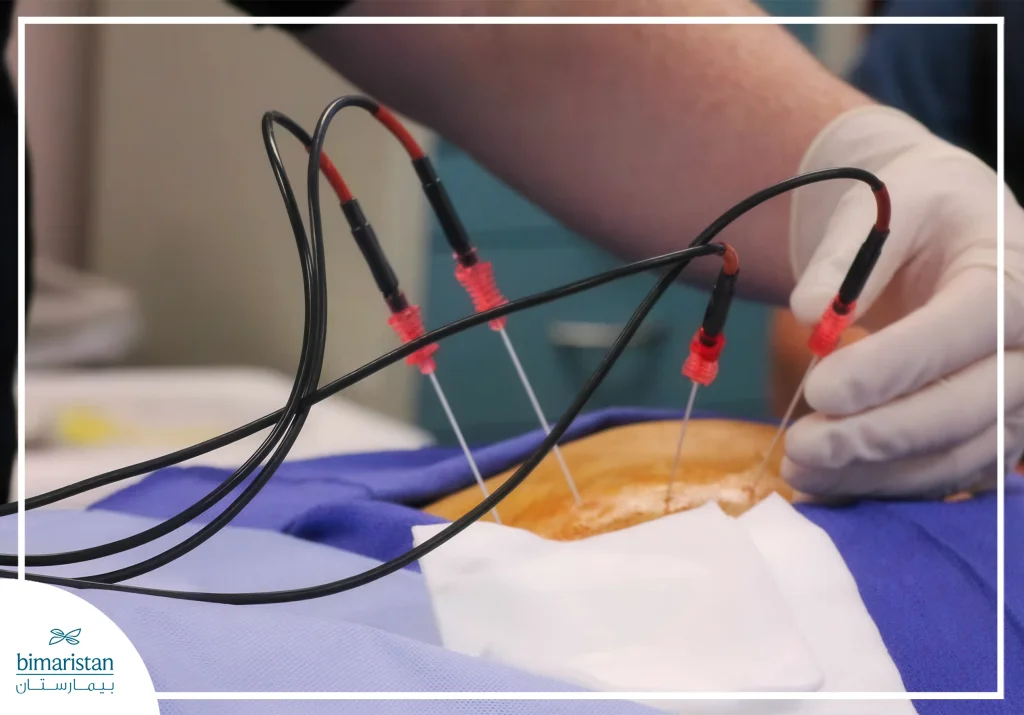 علاج الديسك بالترددات الراديوية (Radiofrequency): راحة طويلة دون جراحة! 2 إدخال الإبرة أثناء عملية علاج الديسك بالترددات الراديوية