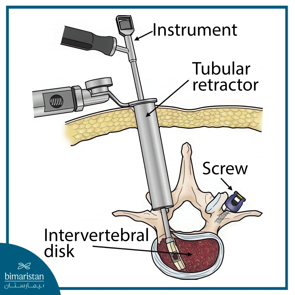 Discectomy Cost In Turkey: The Comprehensive Guide To 2025 2 An Image Showing Discectomy Process And The Tools Utilized During The Procedure