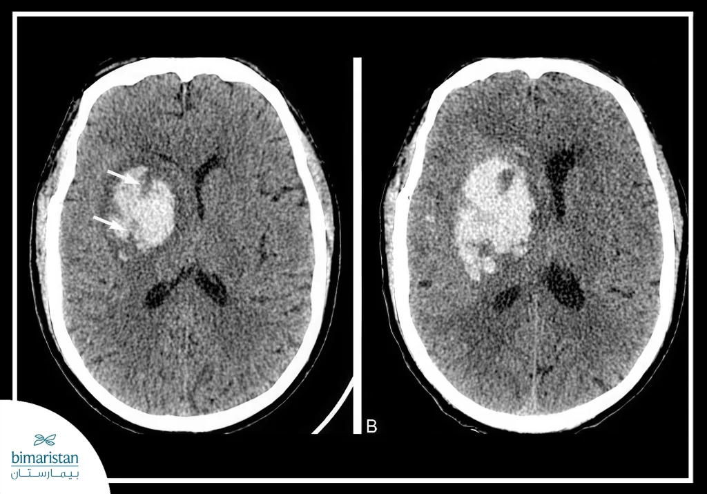 Cerebral Hemorrhage Angiostomy Treatment: X-Ray Showing Cerebral Hemorrhage