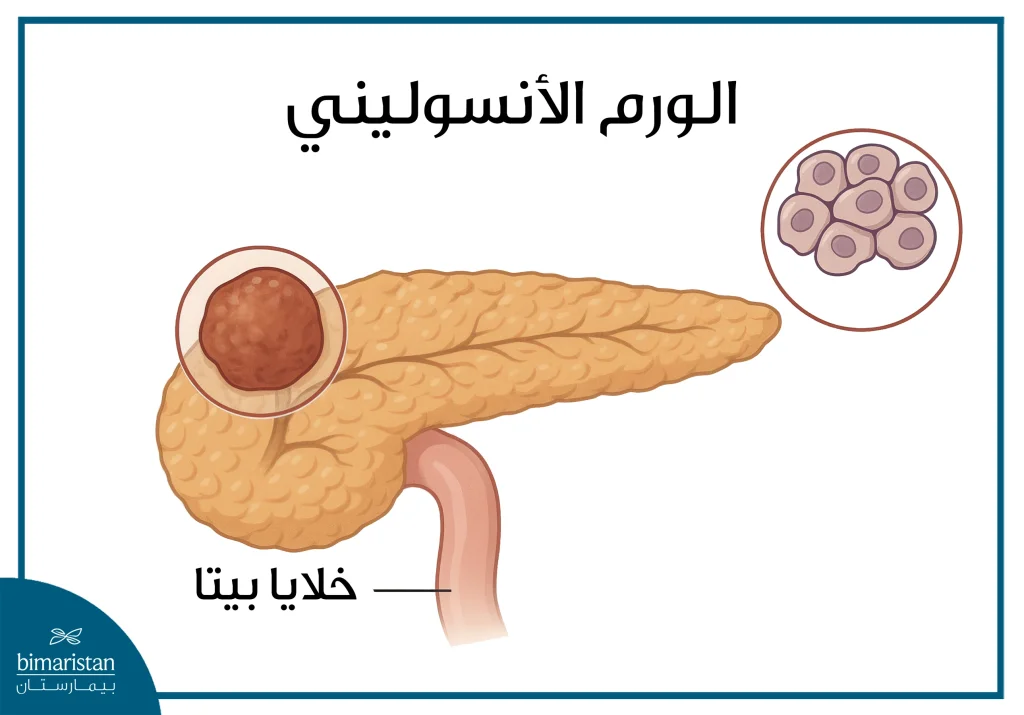 علاج الورم الأنسوليني: الطرق الحديثة والتحكم في أعراض انخفاض السكر 3 صورة توضح موضع الورم الأنسوليني ونوع الخلايا التي يصيبها، والتي تلعب دورًا رئيسيًا في التخطيط للعلاج المناسب للورم الأنسوليني.