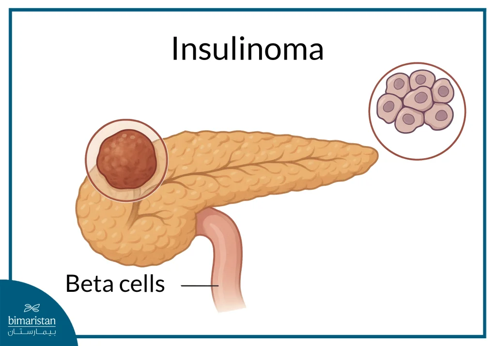 Insulinoma Treatment: Modern Approaches And Managing Low Blood Sugar Symptoms 3 An Image Showing The Position Of An Insulinoma And The Type Of Cells It Affects, Which Plays A Key Role In Planning The Appropriate Insulinoma Treatment.