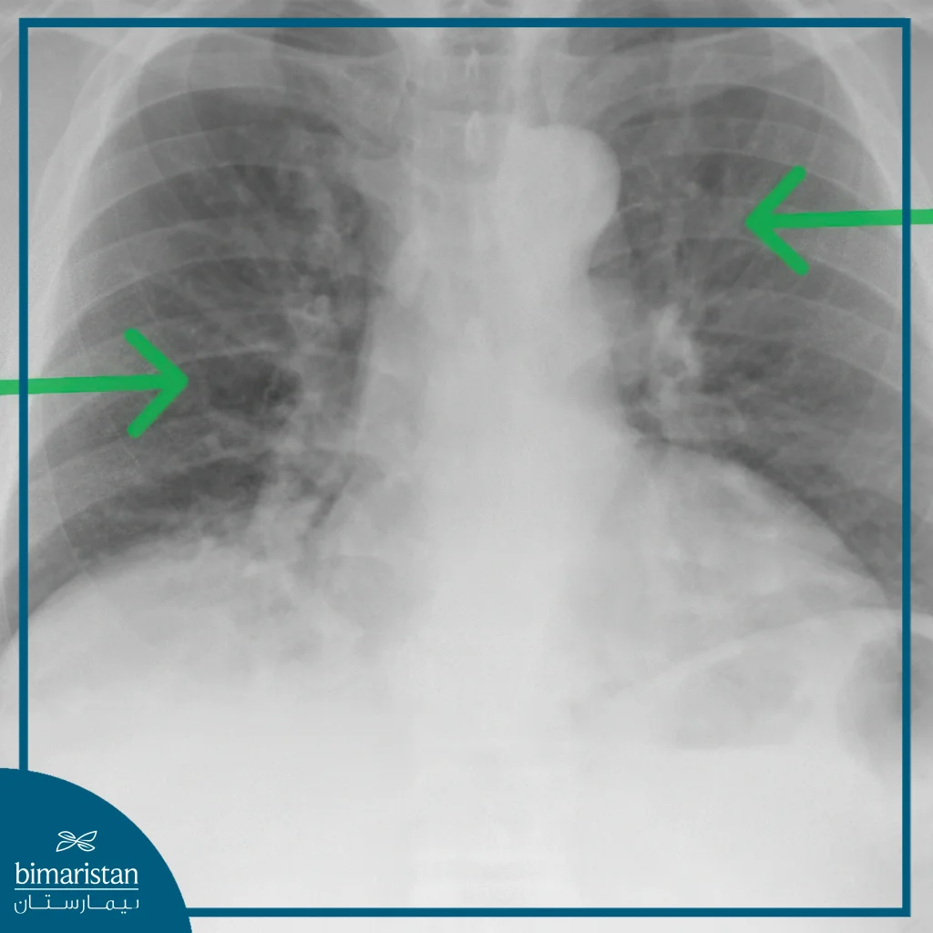 Pulmonary Embolism Treatment: Causes, Symptoms, And Prevention Guide 3 Radiograph Showing A Clear Case Requiring Pulmonary Embolism Treatment.