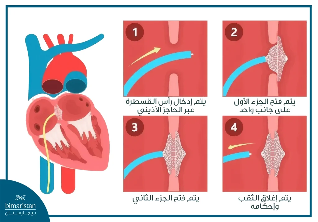 علاج تشوهات القلب عند الأطفال حديثي الولادة: الدليل الكامل من التشخيص إلى التعافي 5 إصلاح عيب الحاجز الأذيني في علاج تشوهات القلب عند الأطفال حديثي الولادة