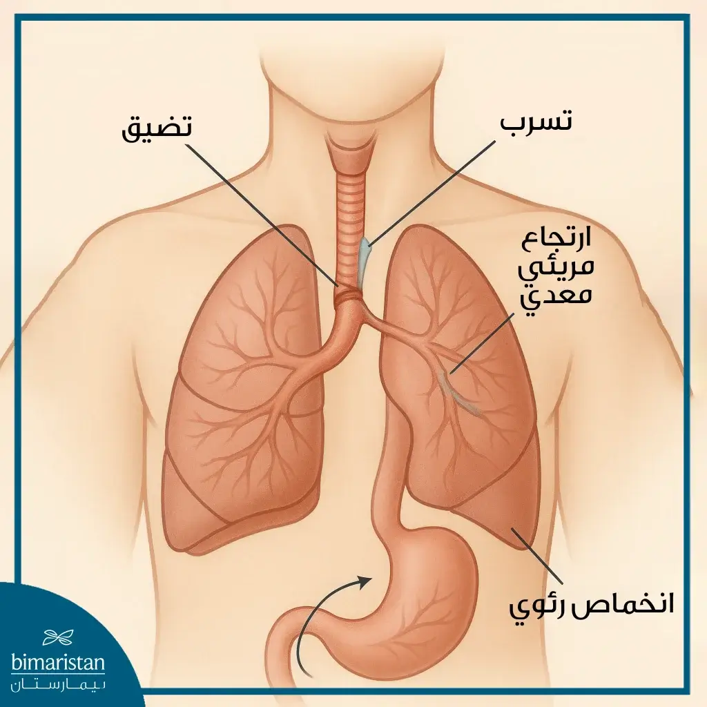 أهم المضاعفات بعد علاج رتق المريء والناسور الرغامي