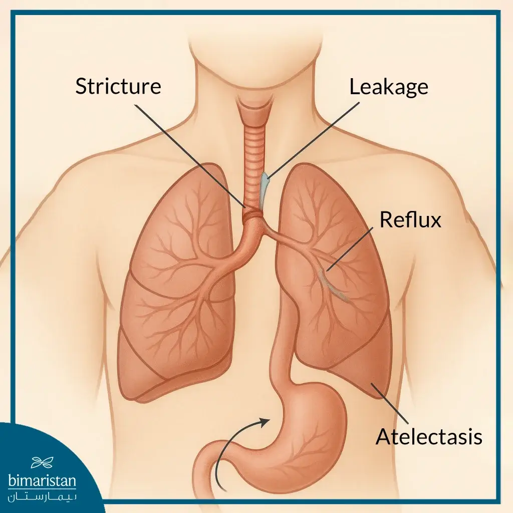Esophageal Atresia Treatment &Amp; Tracheoesophageal Fistula Repair Guide 5 Major Complications After Esophageal Atresia And Tracheoesophageal Fistula Treatment