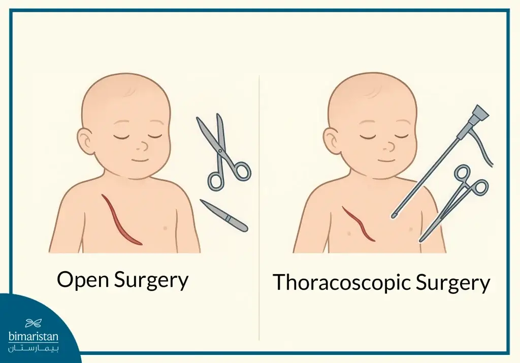 Esophageal Atresia Treatment &Amp; Tracheoesophageal Fistula Repair Guide 4 Tracheoesophageal Fistula And Esophageal Atresia Treatment Methods