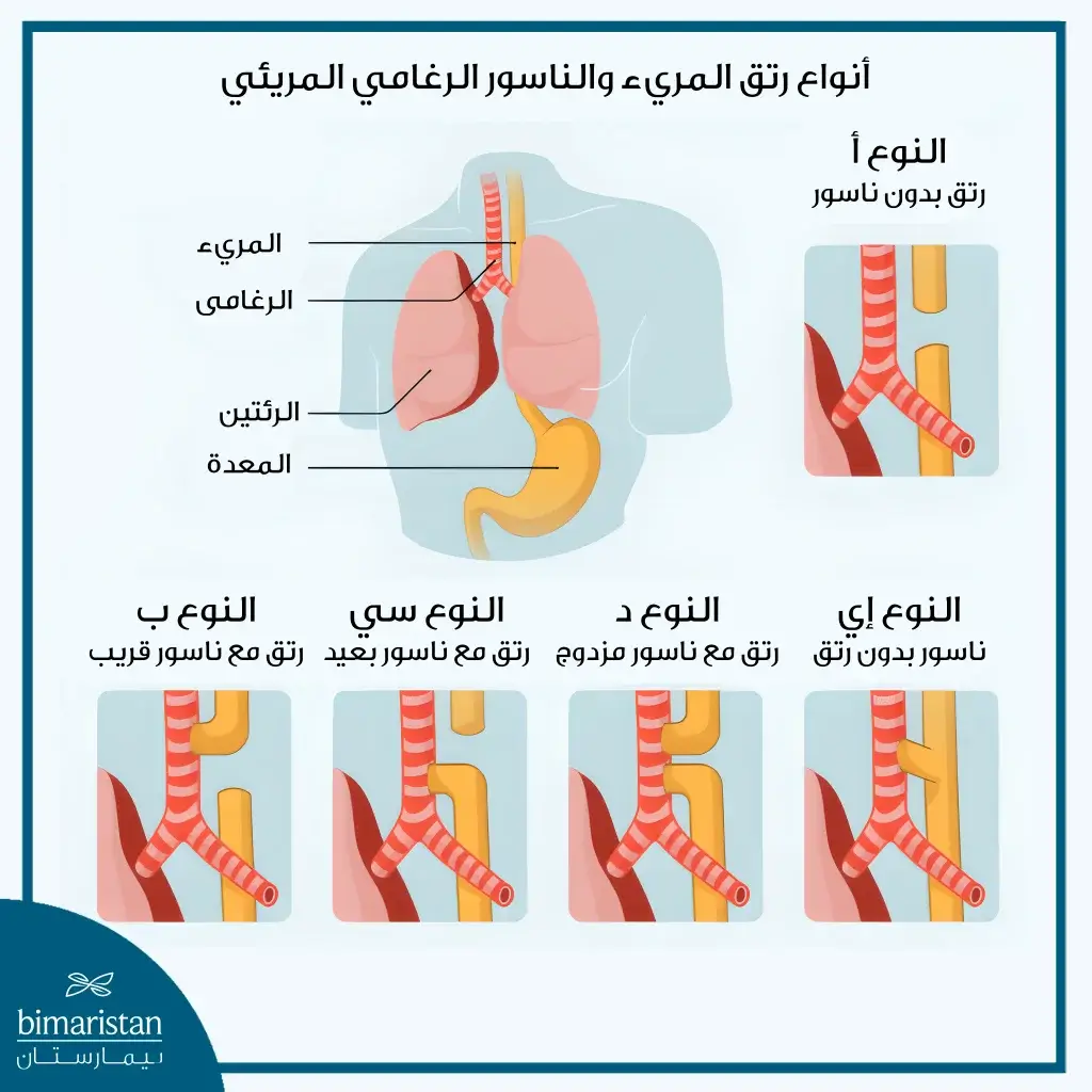 أنواع رتق المريء والناسور الرغامي