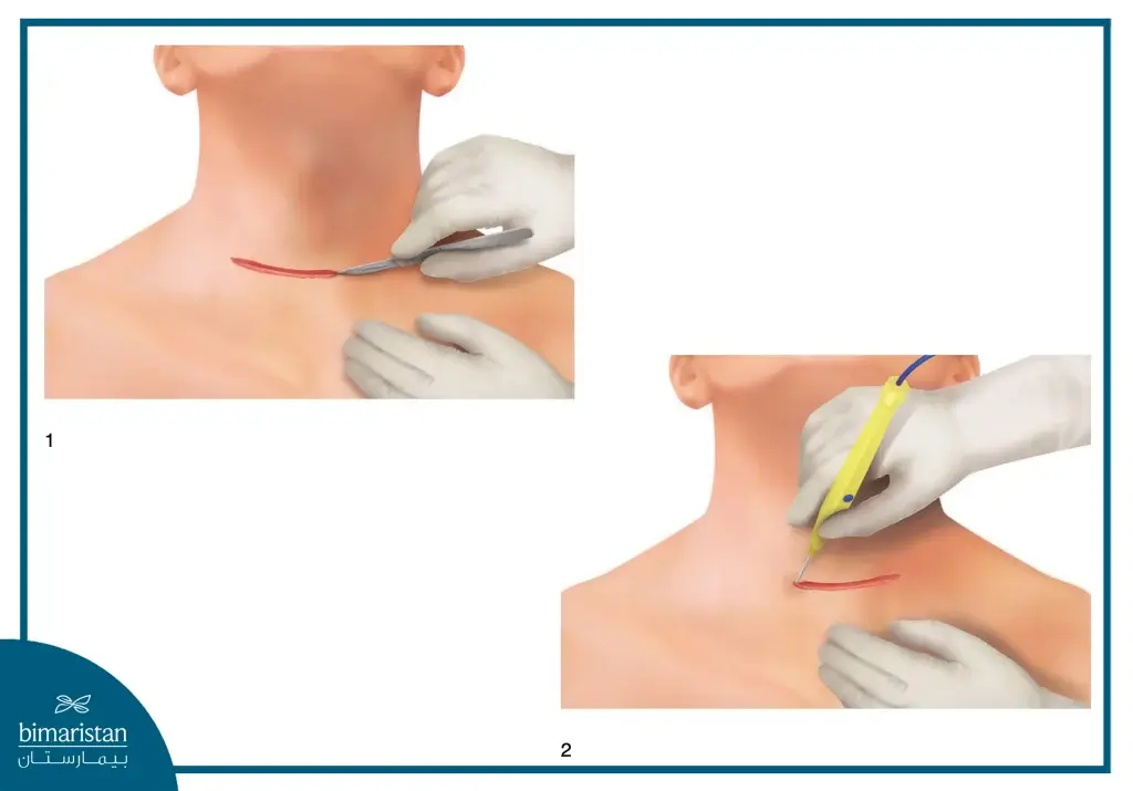 Thyroidectomy: Procedure, Risks, Recovery, And What You Need To Know 3 An Image Showing The Incision Site In A Thyroidectomy