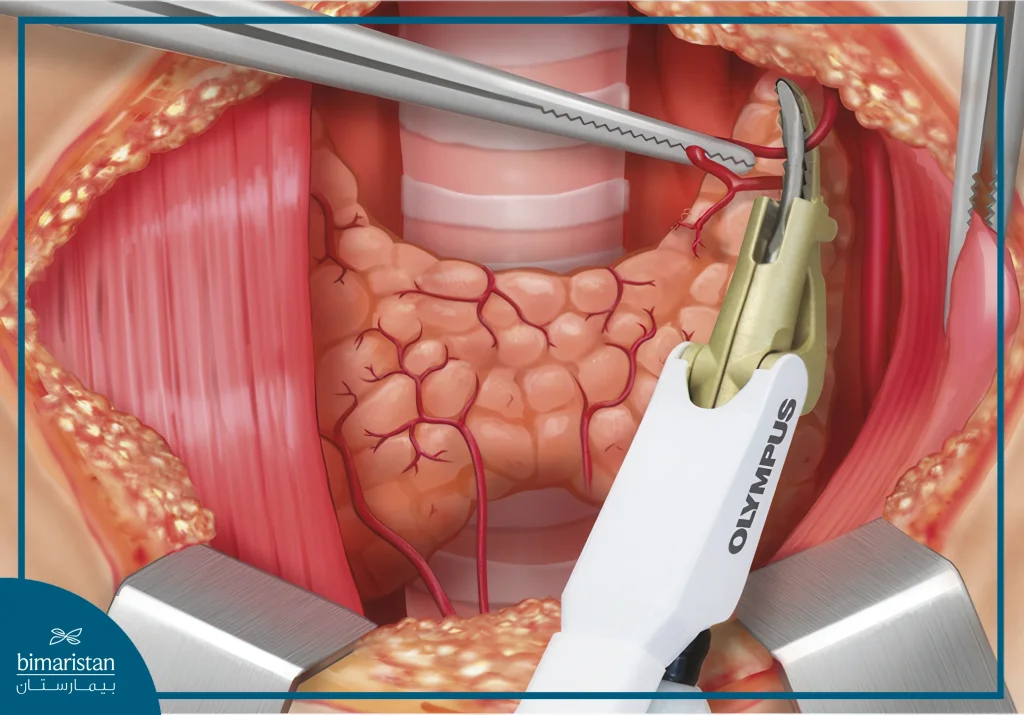 Thyroidectomy: Procedure, Risks, Recovery, And What You Need To Know 4 Image During A Traditional Thyroidectomy Procedure In Turkey