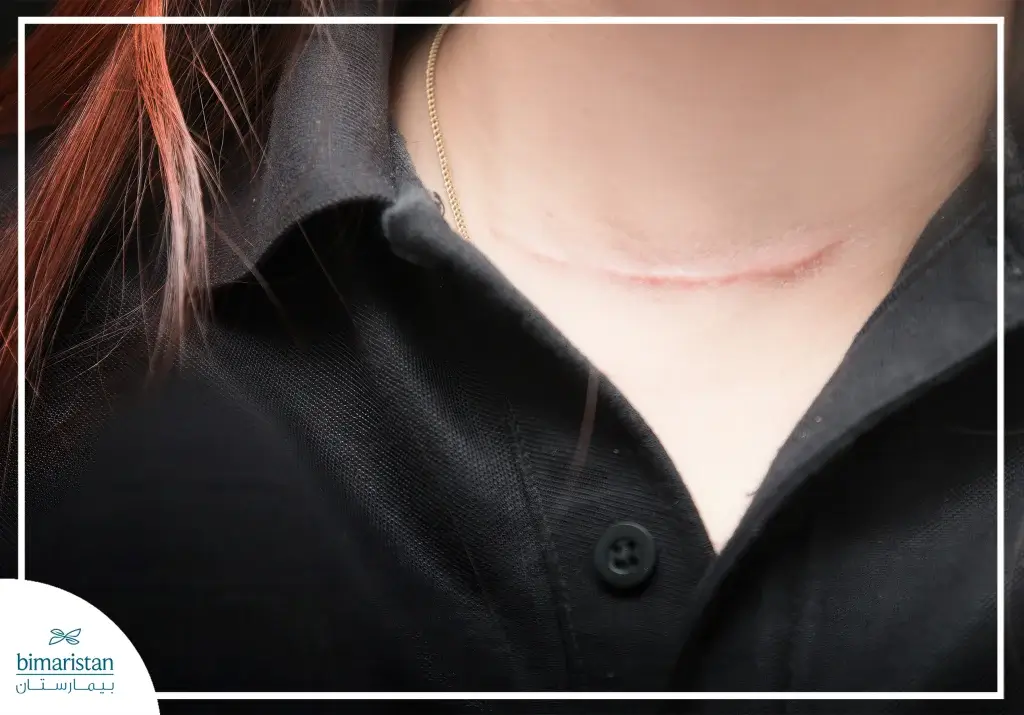 Thyroidectomy: Procedure, Risks, Recovery, And What You Need To Know 5 Image Showing The Shape Of The Neck After Thyroidectomy In Turkey
