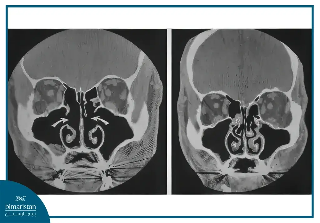 Functional Endoscopic Sinus Surgery: Sinusitis Treatment &Amp; Recovery Guide 3 Before And After Photo Of Functional Endoscopic Sinus Surgery