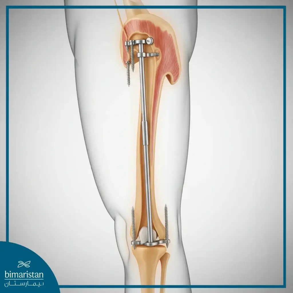 Height Lengthening Procedure With Internal Fixator: New Steps And Prospects 5 The Internal Stabilizer