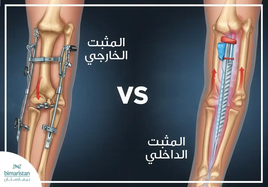 عملية تطويل القامة بالمثبت الداخلي: خطوات وآفاق جديدة 10 الفرق بين عملية تطويل القامة بالمثبت الداخلي والمثبت الخارجي