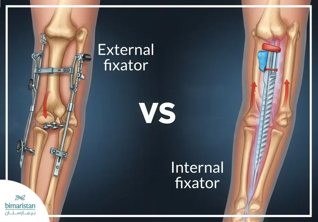 Height Lengthening Procedure With Internal Fixator: New Steps And Prospects 4 The Difference Between The Internal Stabilizer And The External Stabilizer In Height Lengthening