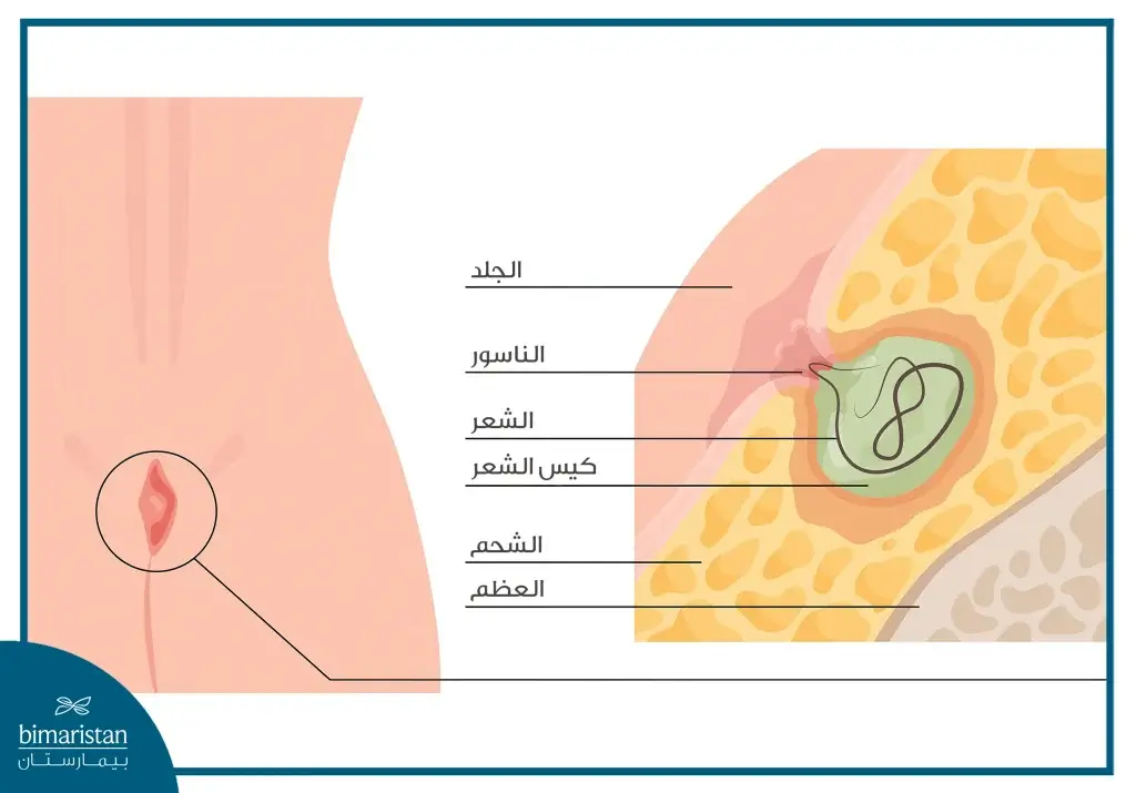 عملية كيس الشعر بالمنظار: حل حديث بدون ألم أو جراحة مفتوحة 3 صورة توضح شكل وتوضع كيسة الشعر