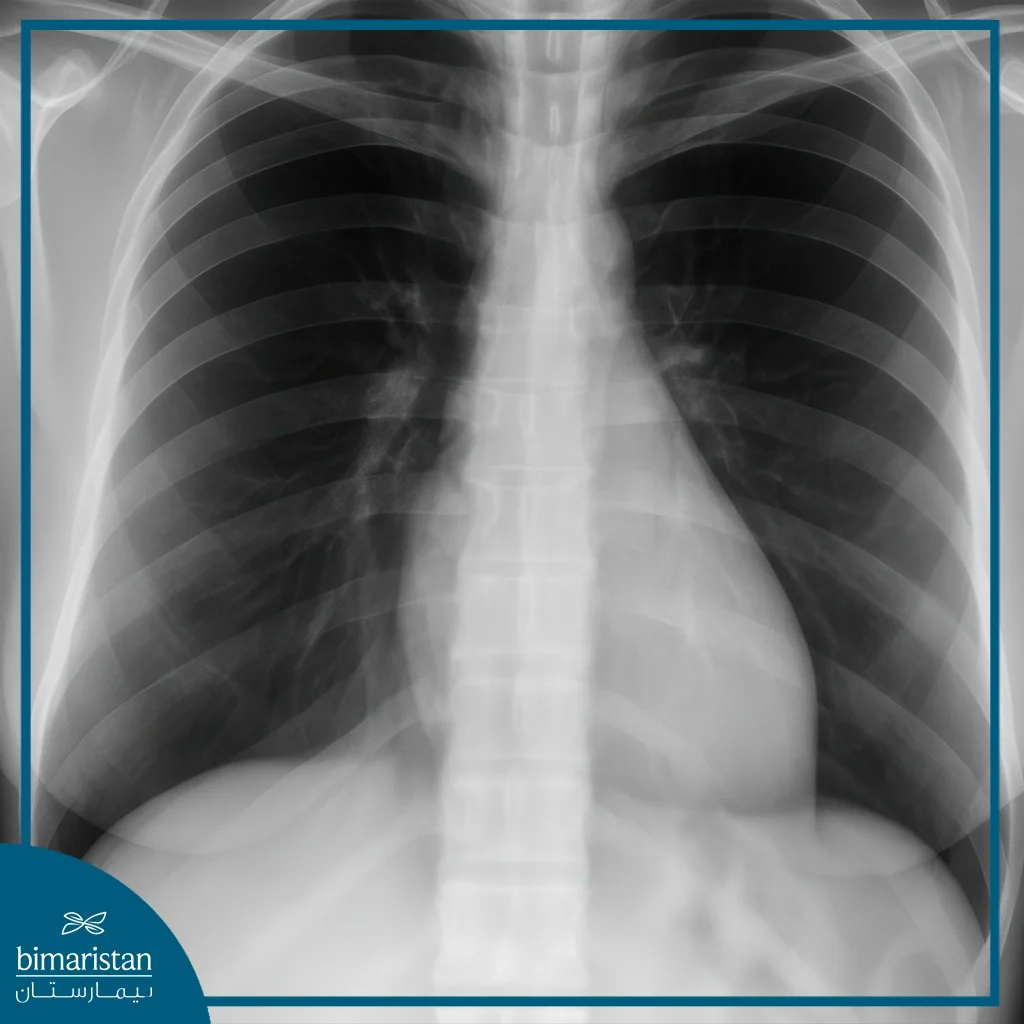 Mediastinal Cysts: Types, Causes, Symptoms, And Treatment Options 3 Radiograph Showing Abnormal Shadows That May Indicate Mediastinal Cysts.