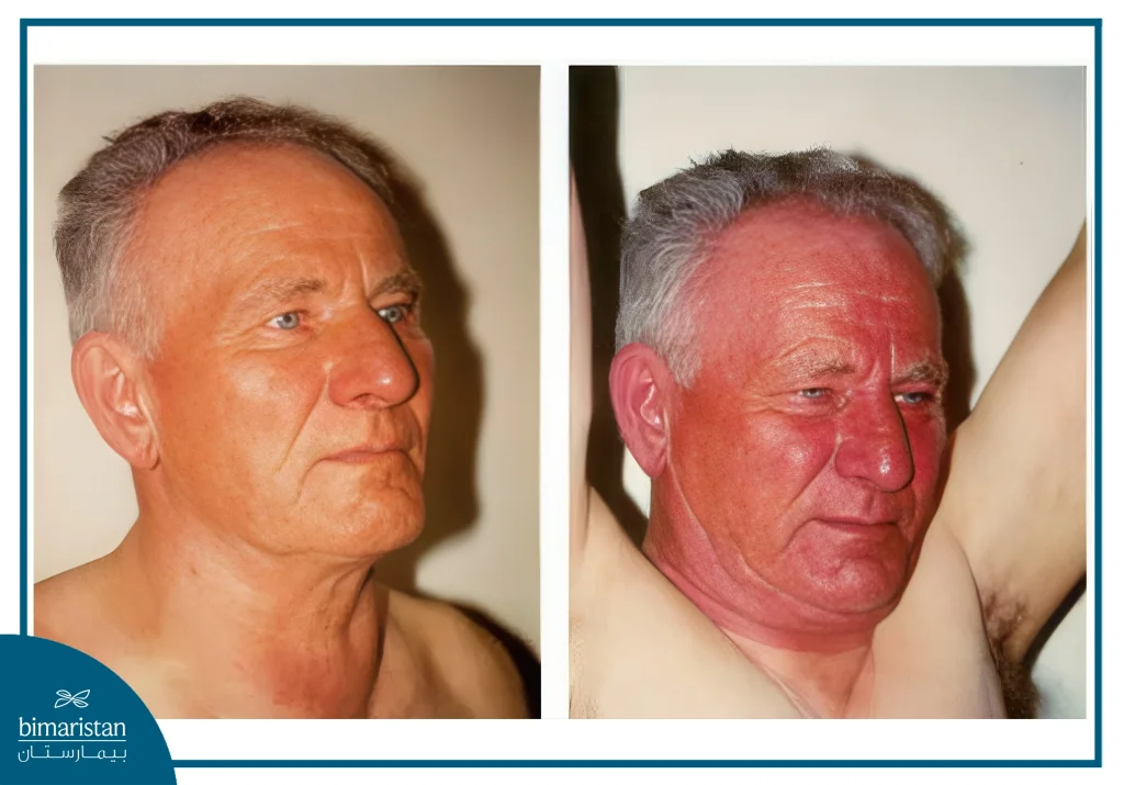 Superior Vena Cava Syndrome: Causes, Symptoms, And Treatment Options 3 An Image Showing A Patient With Superior Vena Cava Syndrome, With Obvious Swelling Of The Face And Neck And Congestion Of Superficial Veins.