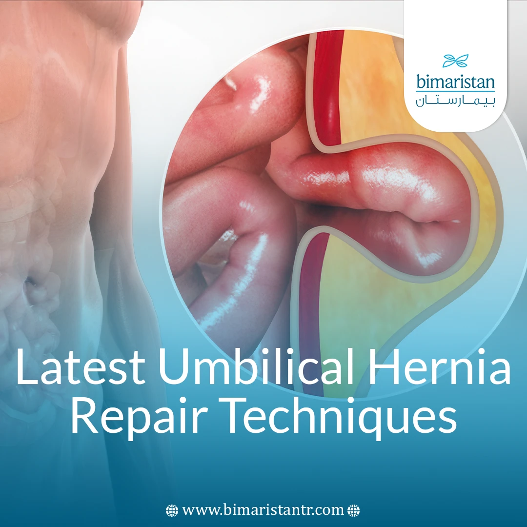 Latest Umbilical Hernia Repair Techniques