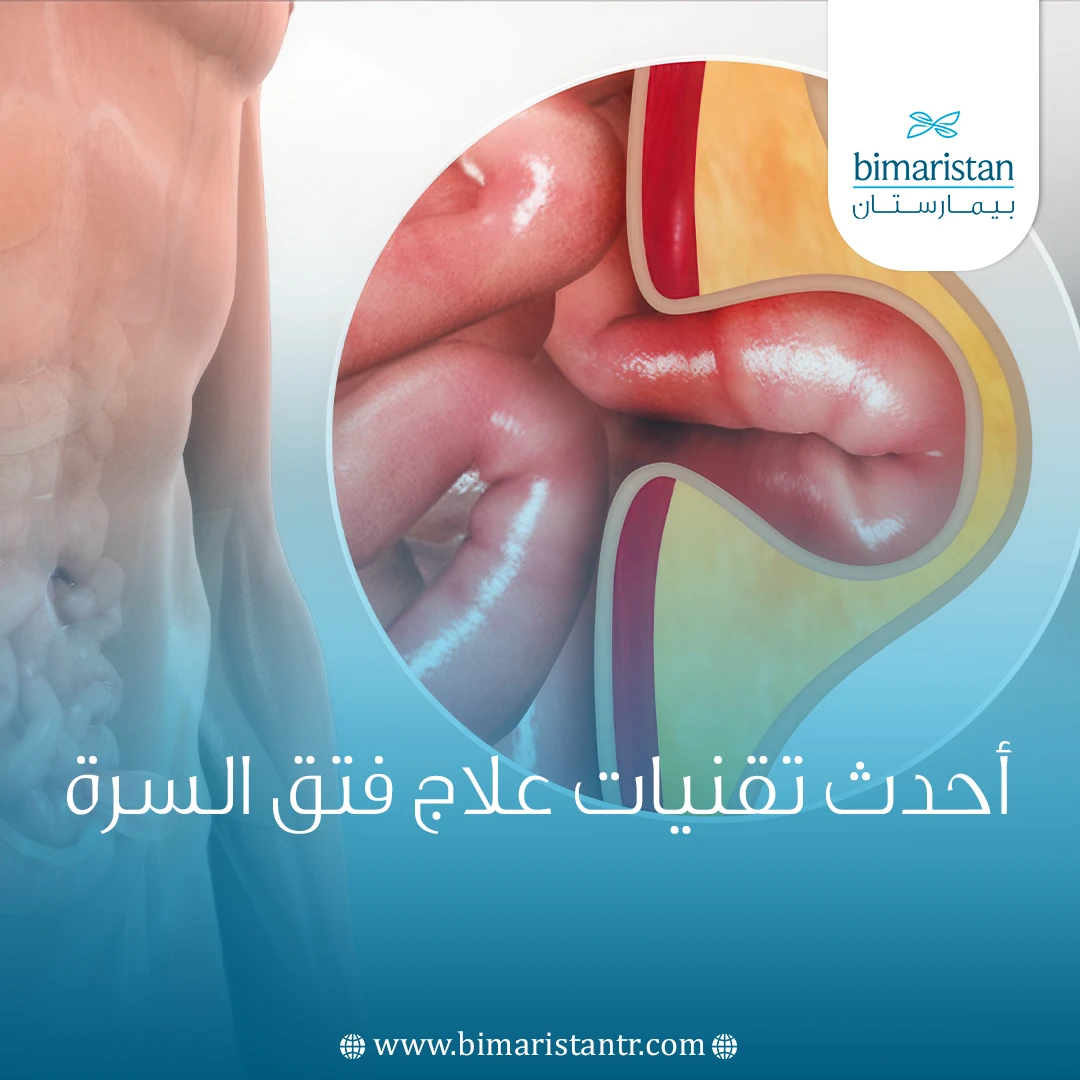 أحدث تقنيات علاج فتق السرة