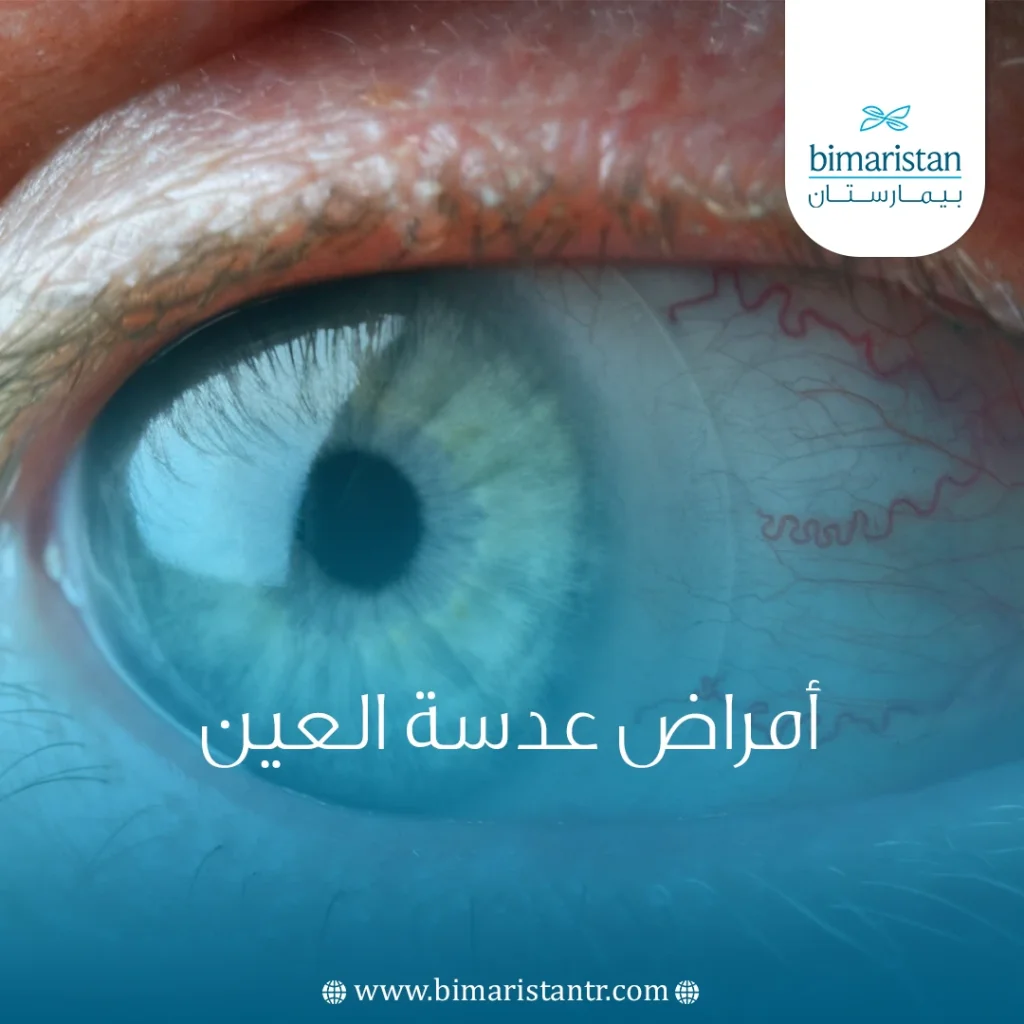 أمراض عدسة العين