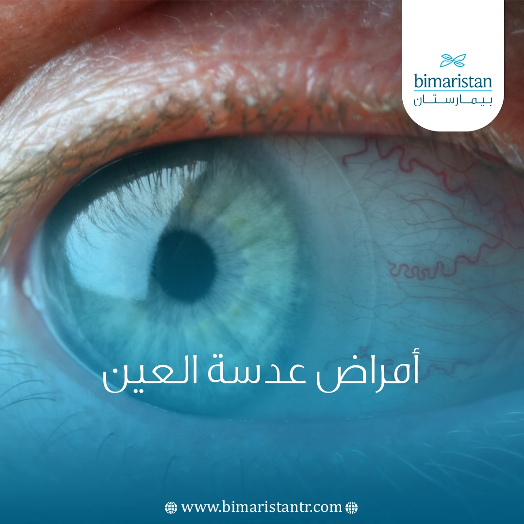 أمراض عدسة العين