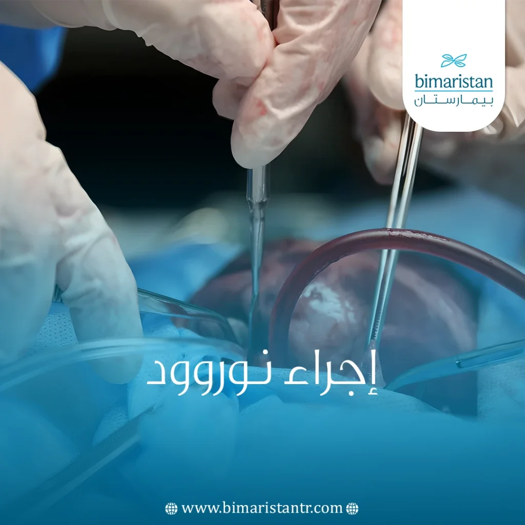 إجراء نوروود