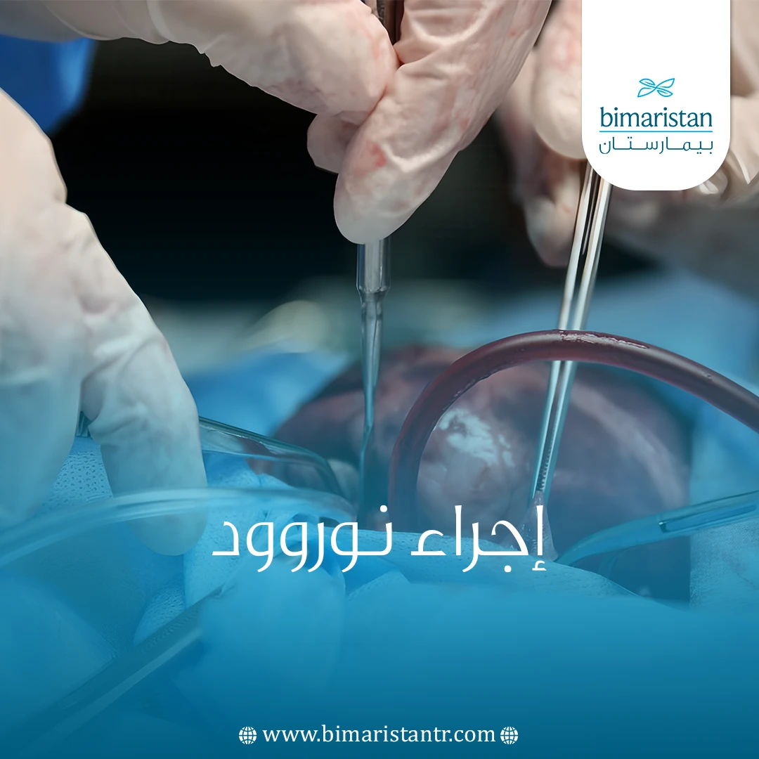 إجراء نوروود