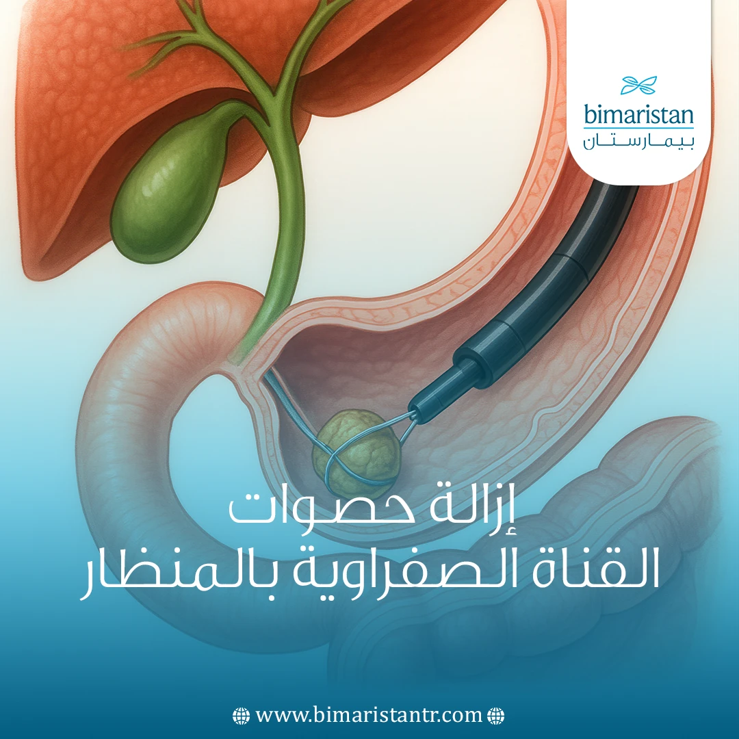 إزالة حصوات القناة الصفراوية بالمنظار