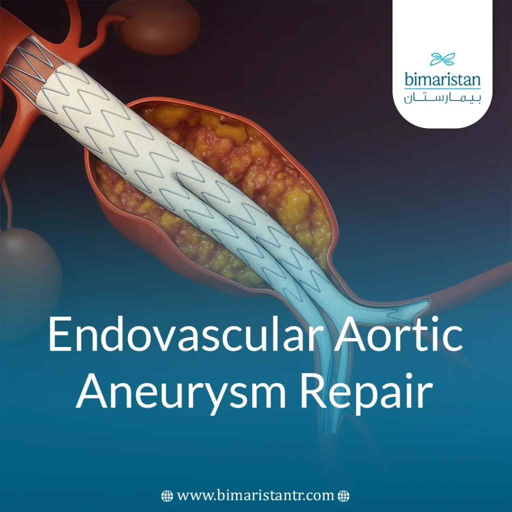 Endovascular Aortic Aneurysm Repair: Non-Surgical Solution