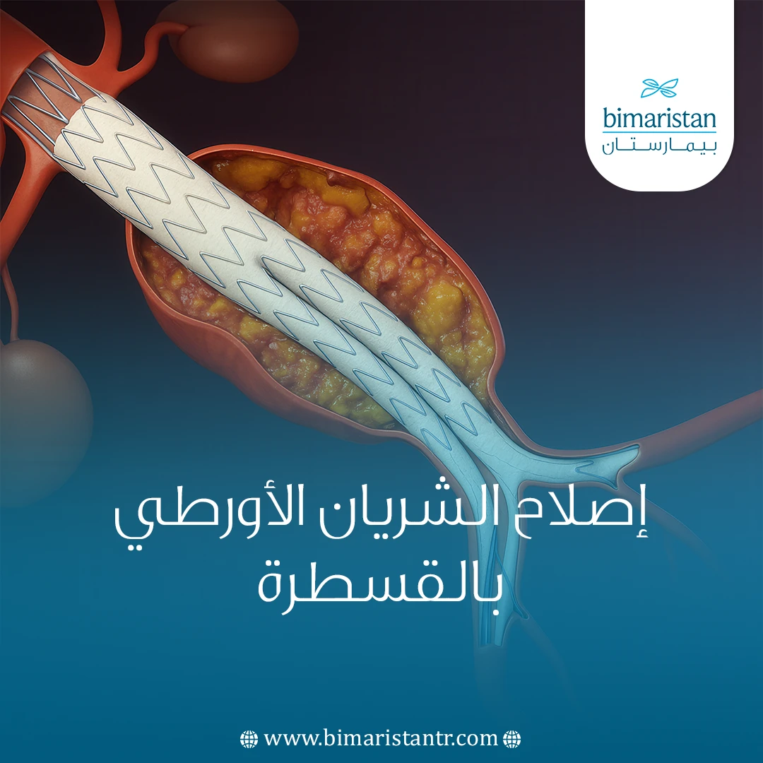 إصلاح الشريان الأورطي بالقسطرة