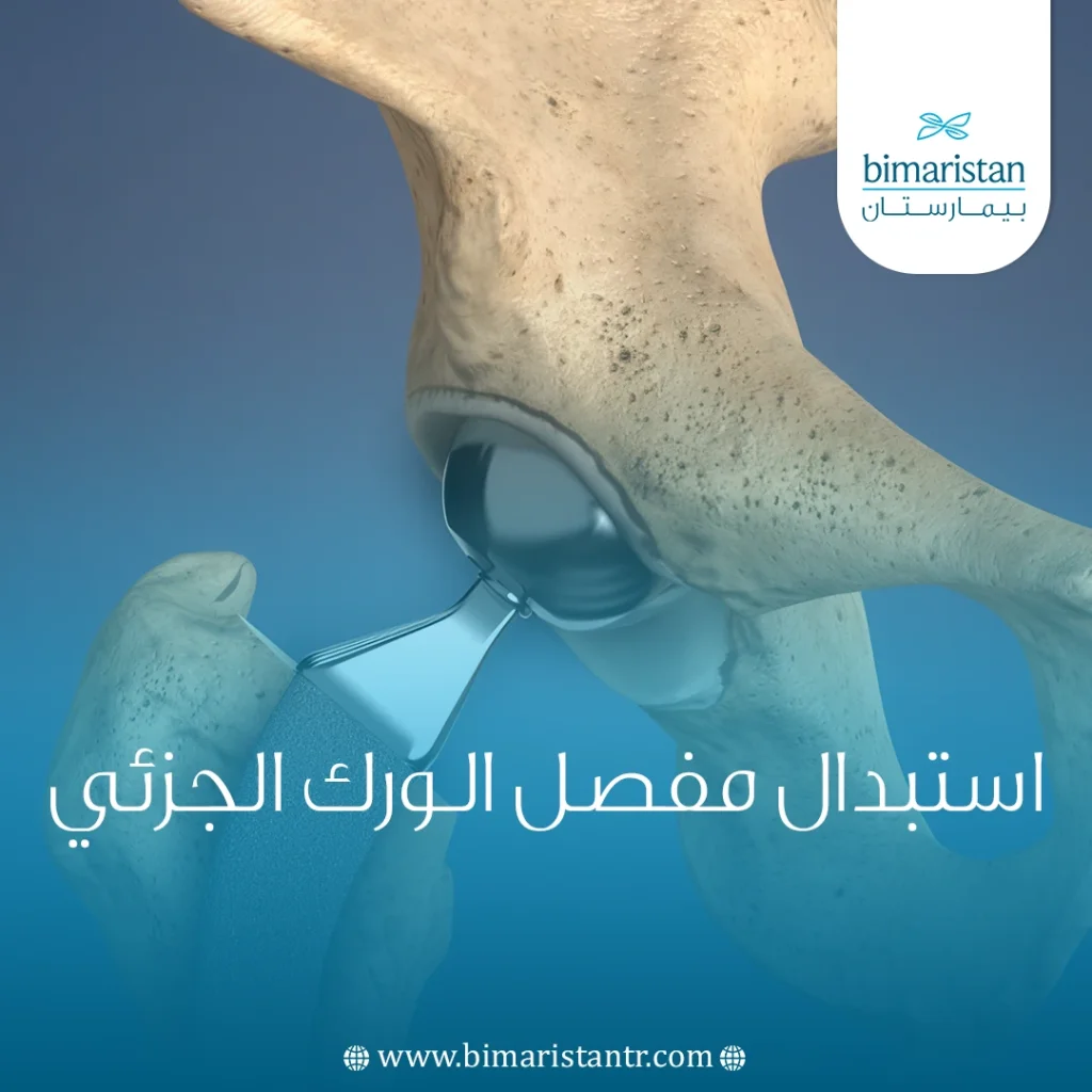 استبدال مفصل الورك الجزئي
