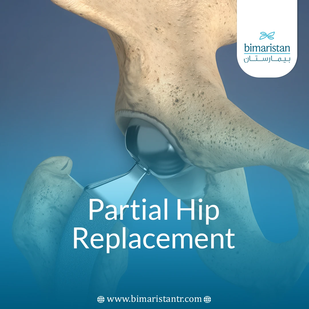Partial Hip Replacement In Turkey: Affordable Expert Care