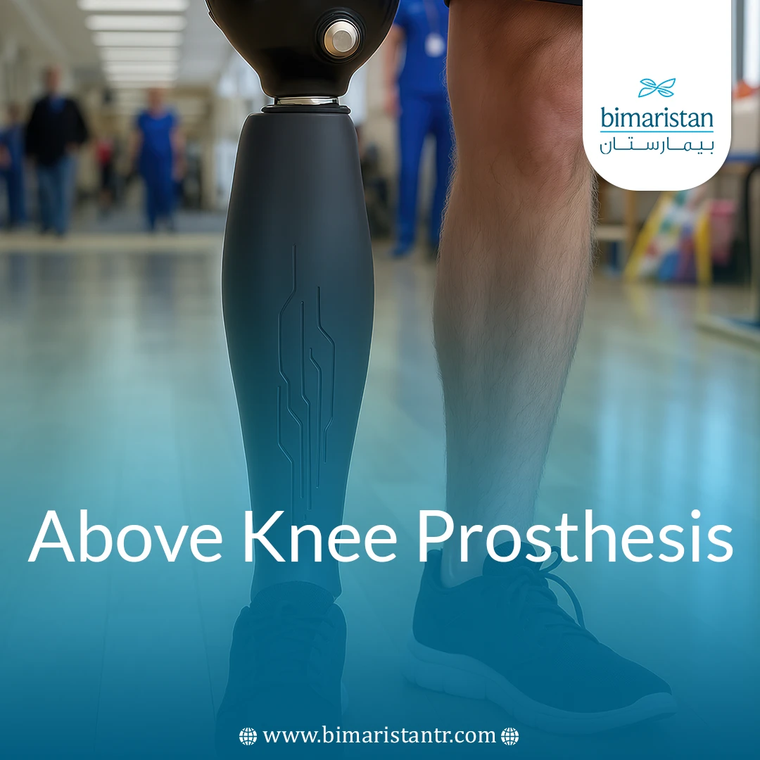 Above-Knee Prosthesis: Types, Benefits, And Mobility Restoration