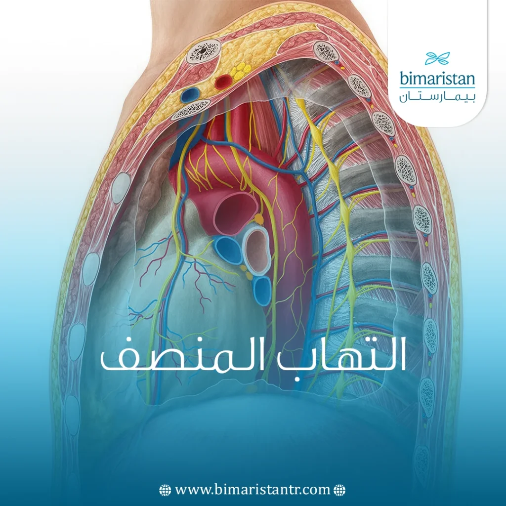 التهاب المنصف