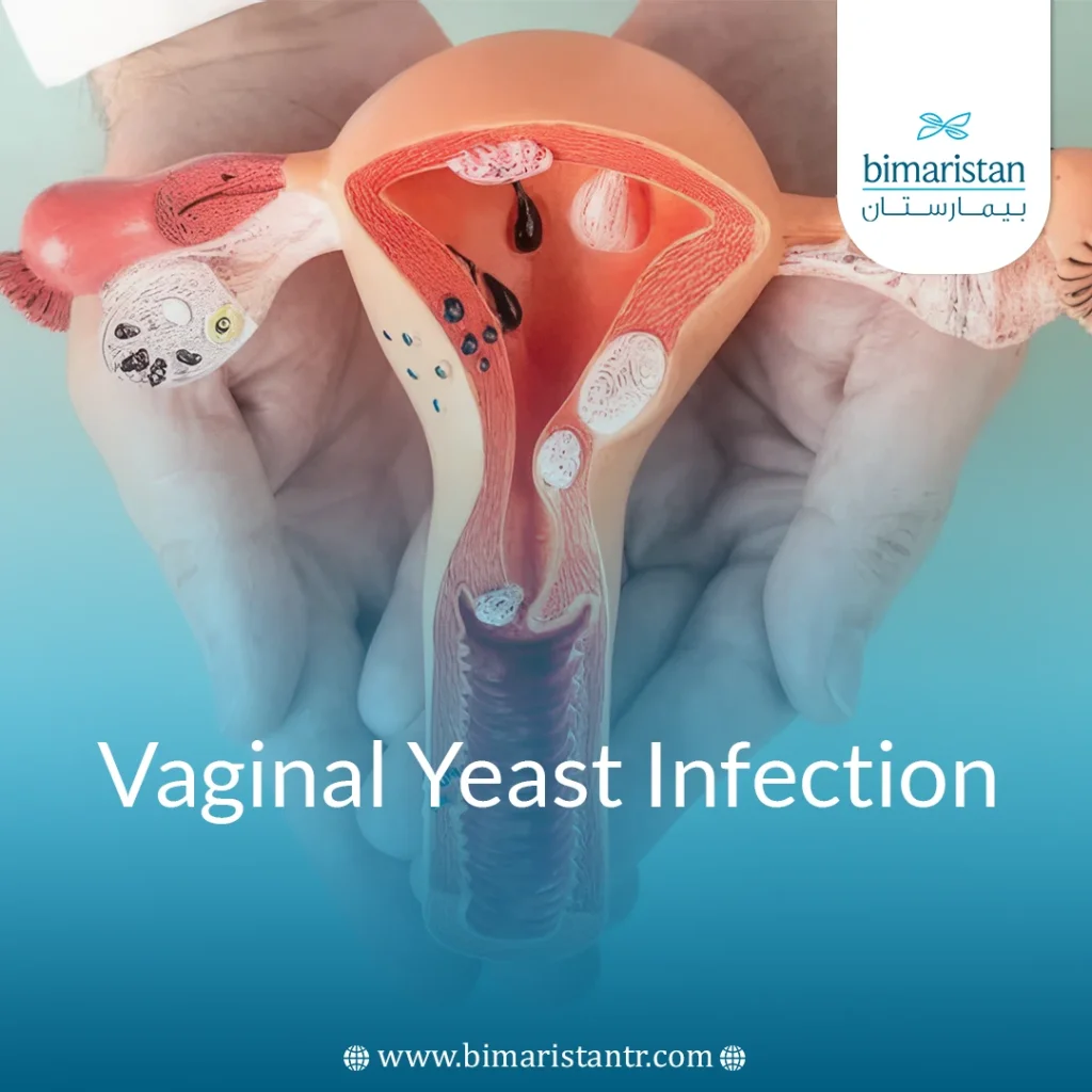 Vaginal Yeast Infection: Symptoms, Causes &Amp; Treatments