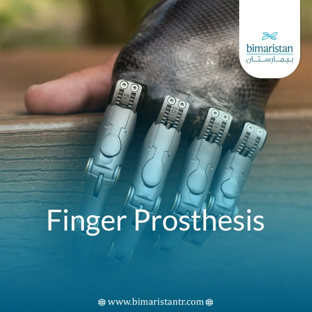 Finger Prosthesis: Realistic, Precise &Amp; Confidence-Boosting
