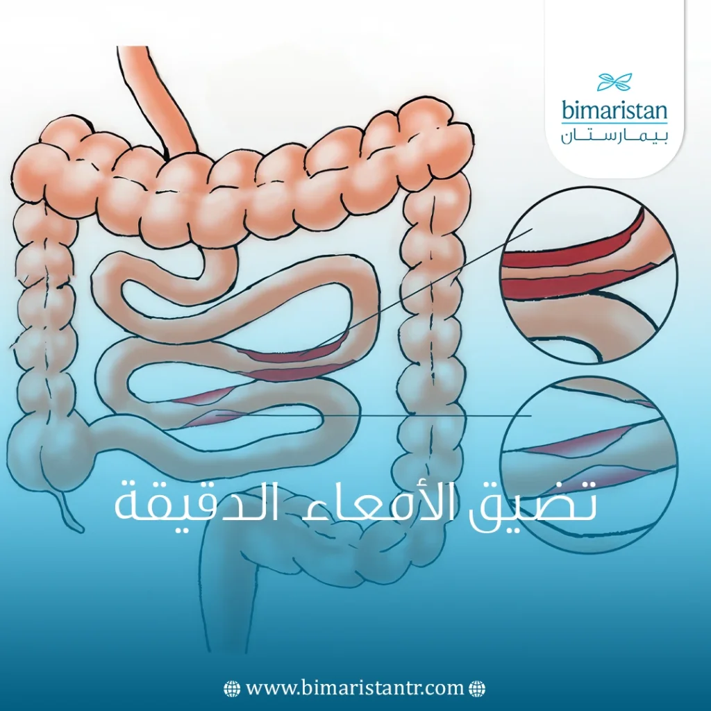 تضيق الأمعاء الدقيقة