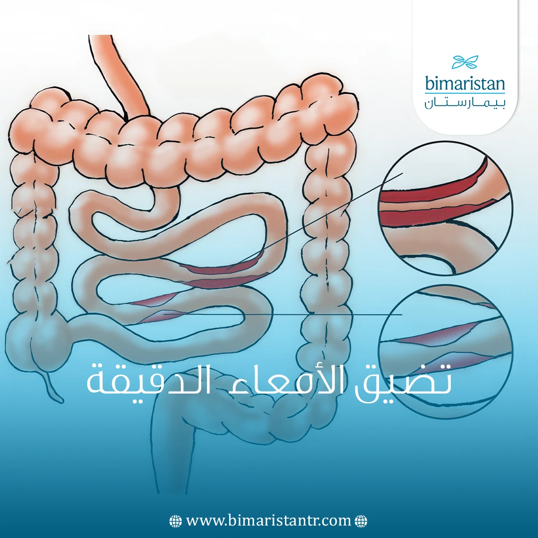 تضيق الأمعاء الدقيقة