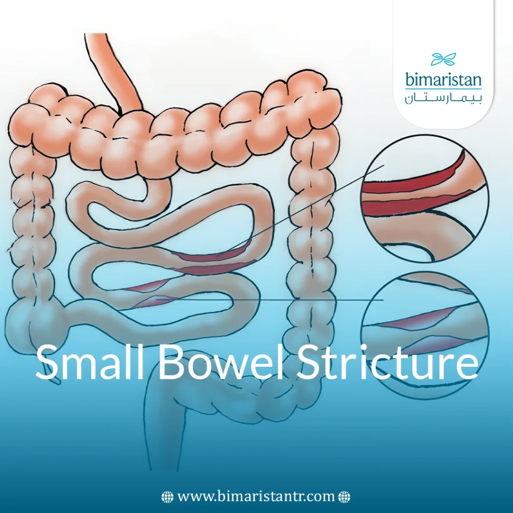 Small Bowel Stricture: Causes, Symptoms, And Treatment