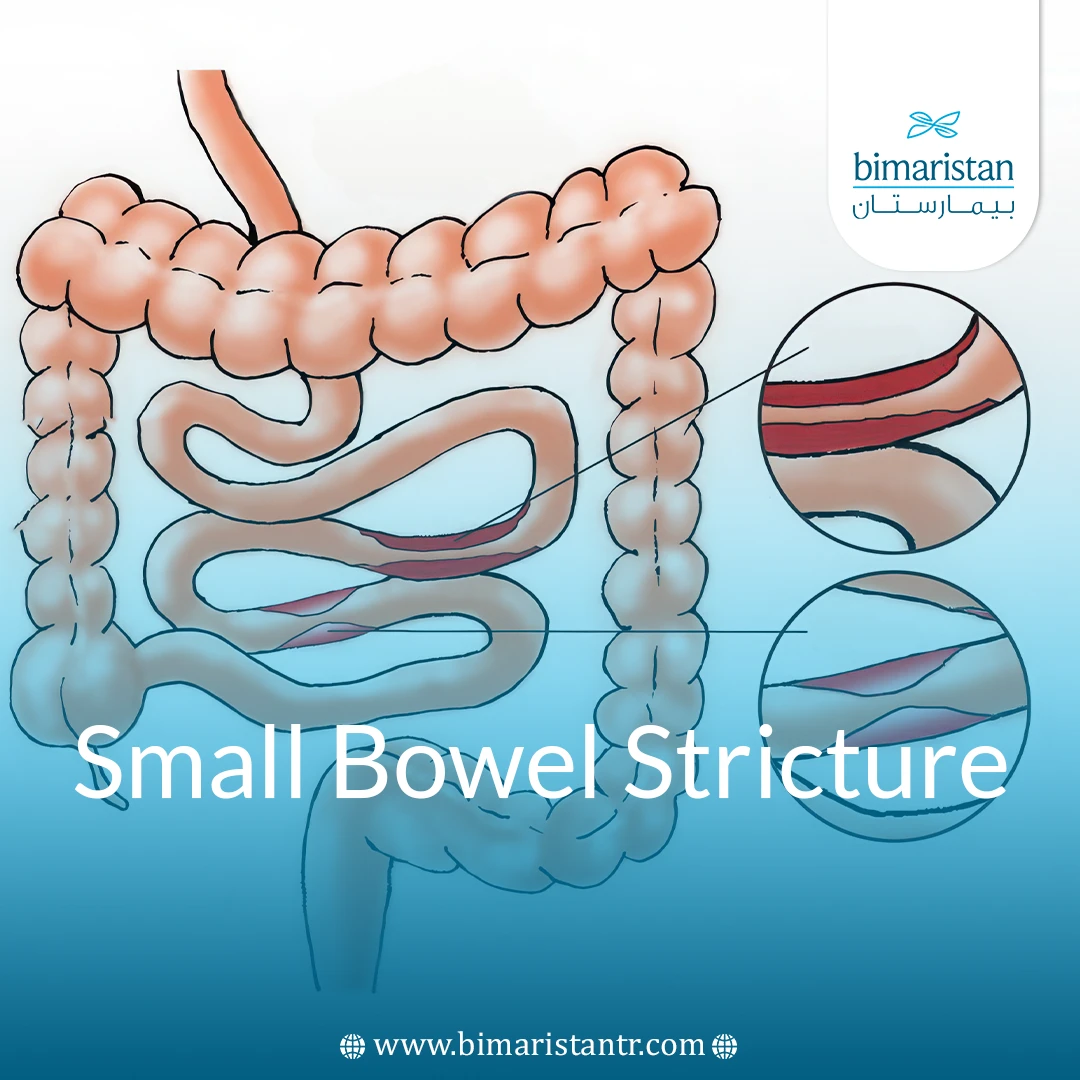 Small Bowel Stricture: Causes, Symptoms, And Treatment