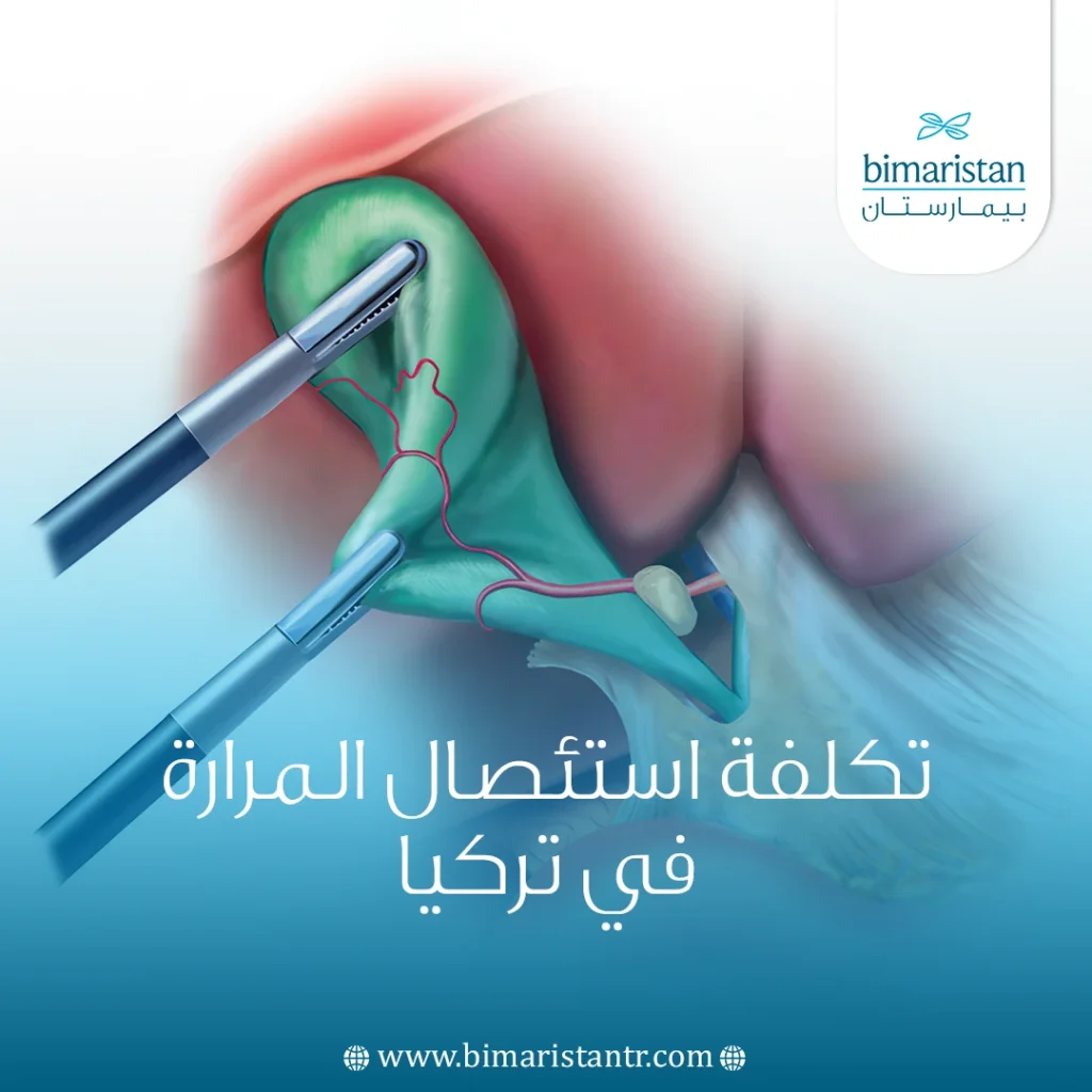 تكلفة استئصال المرارة في تركيا