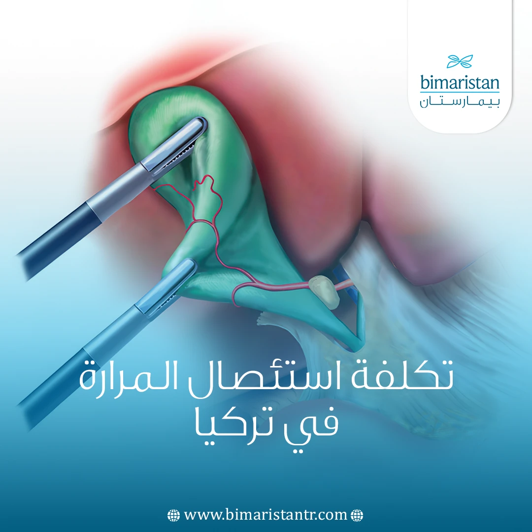 تكلفة استئصال المرارة في تركيا