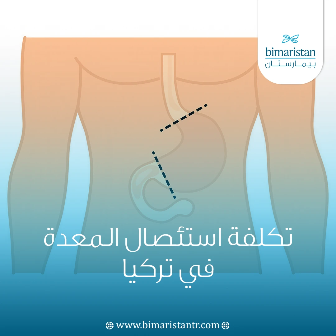 تكلفة استئصال المعدة في تركيا: كل ما تحتاج معرفته قبل السفر