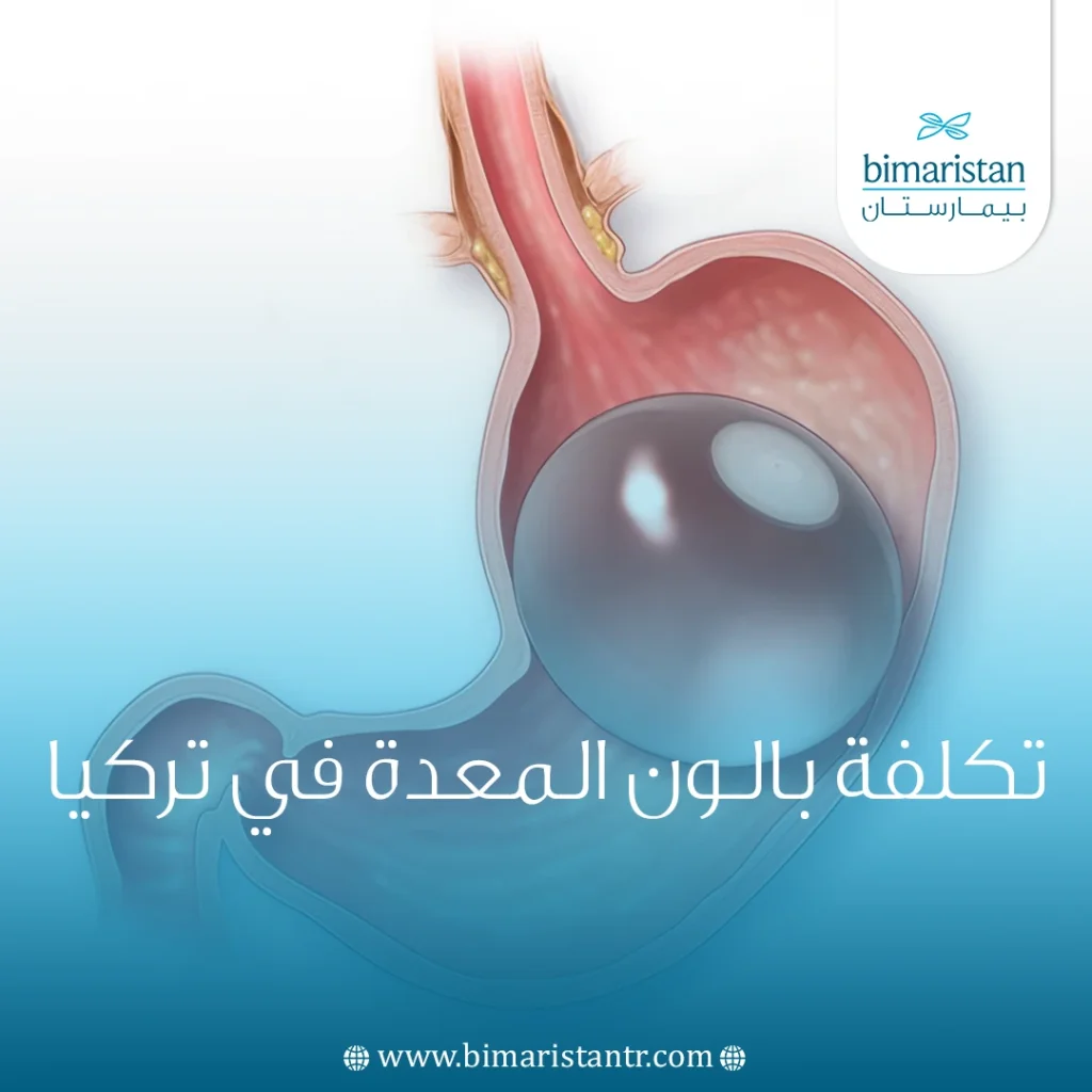 تكلفة بالون المعدة في تركيا