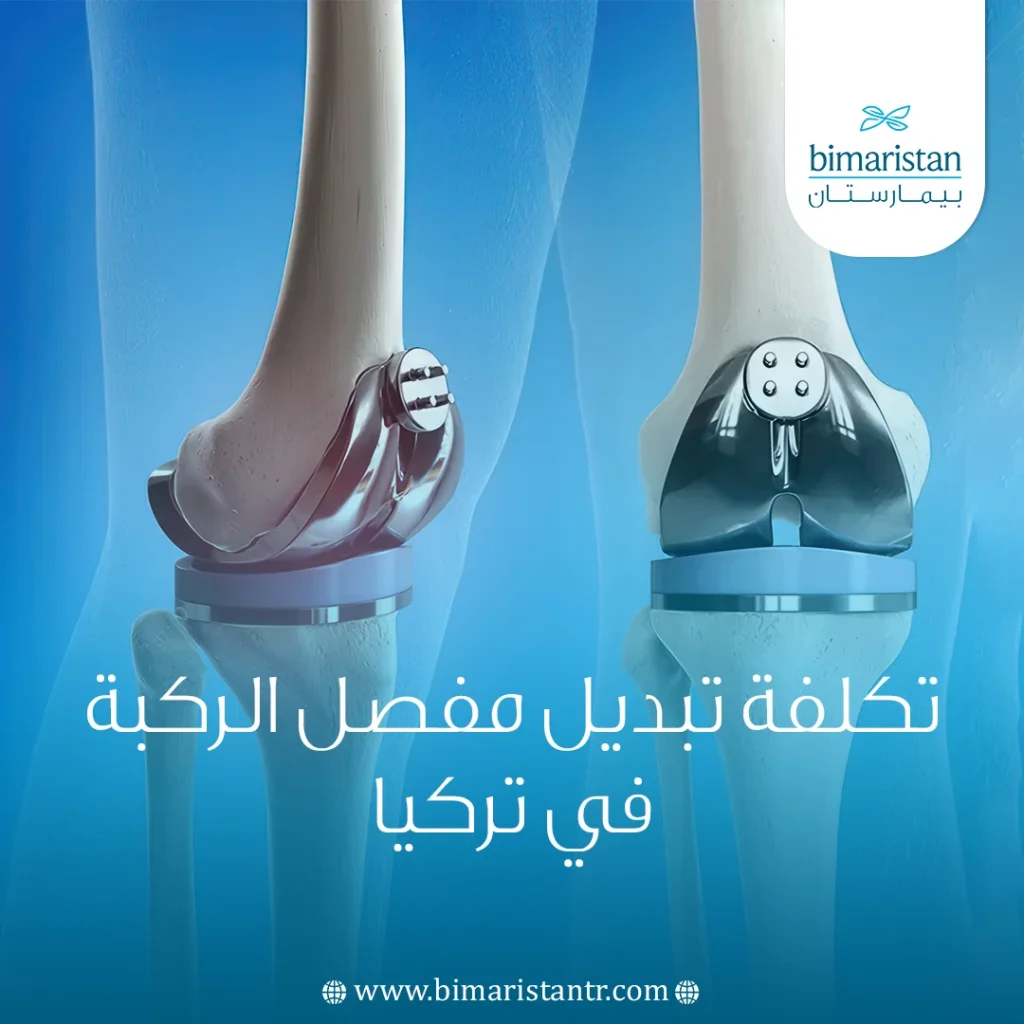 تكلفة تبديل مفصل الركبة في تركيا