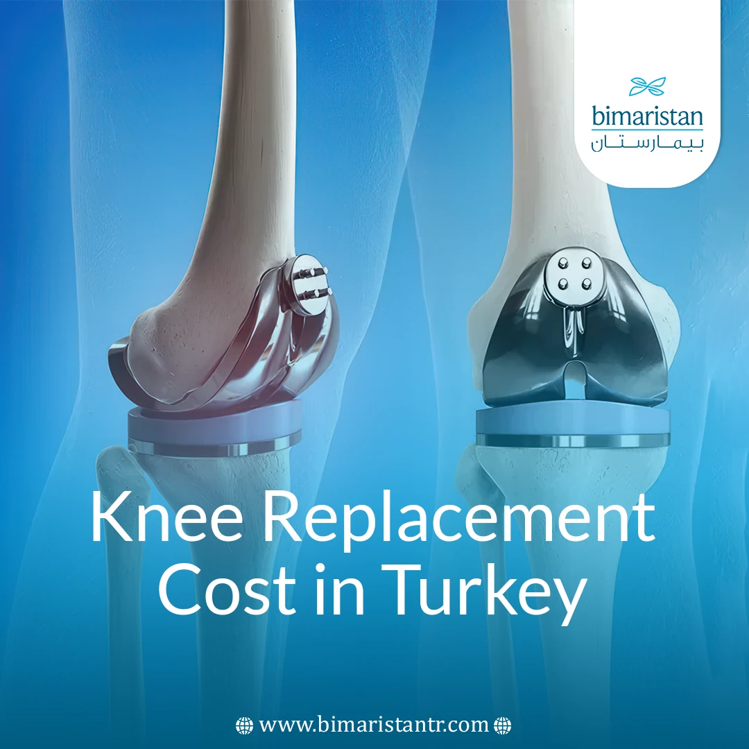 Knee Replacement Cost In Turkey 2025: Best Care With Best Prices
