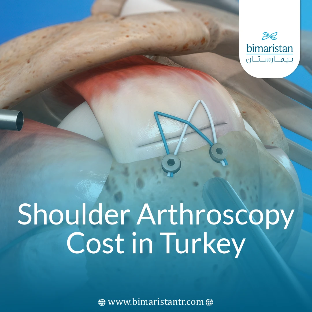 Shoulder Arthroscopy Cost In Turkey 2025: World-Class Quality With Unbelievable Prices