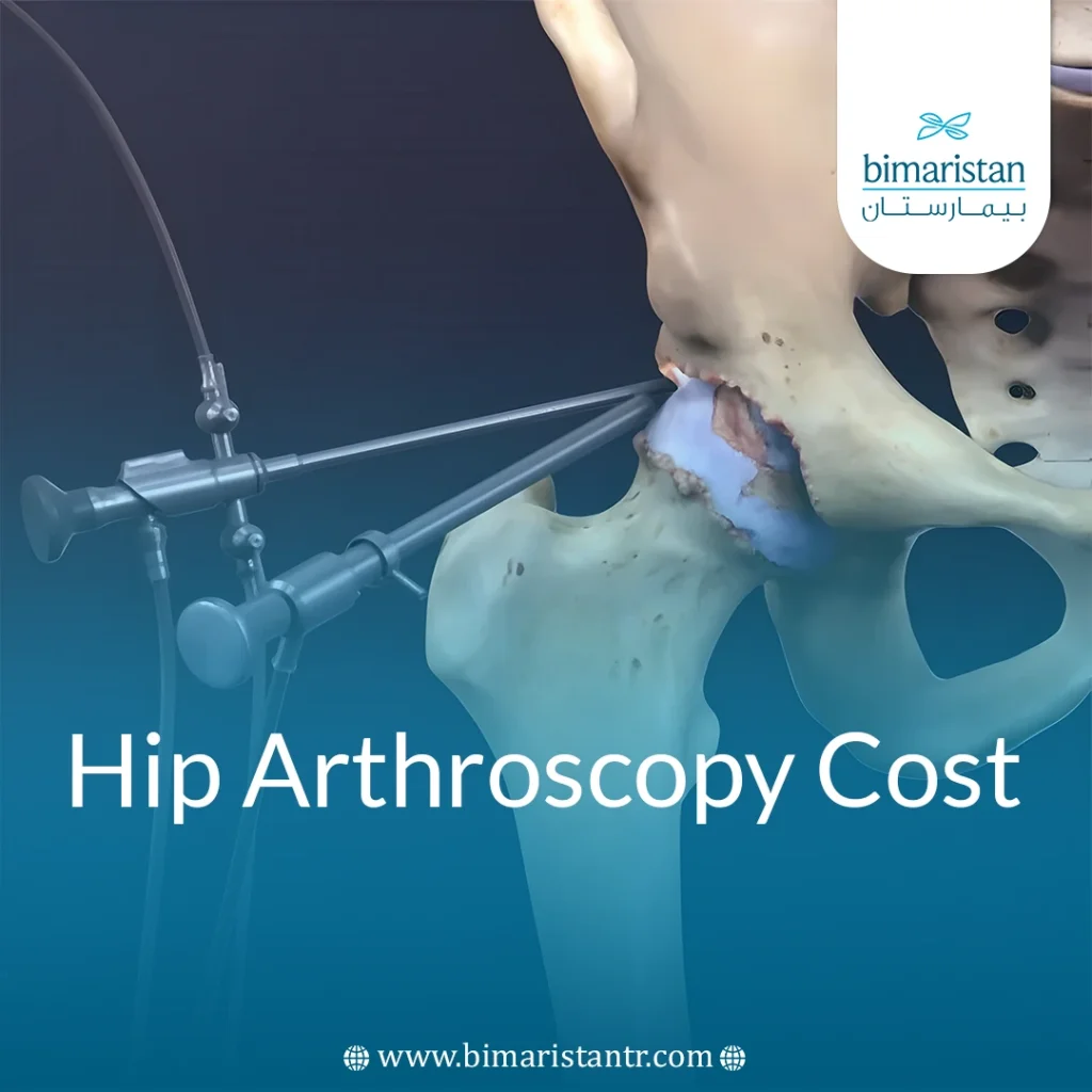 Hip Arthroscopy Cost