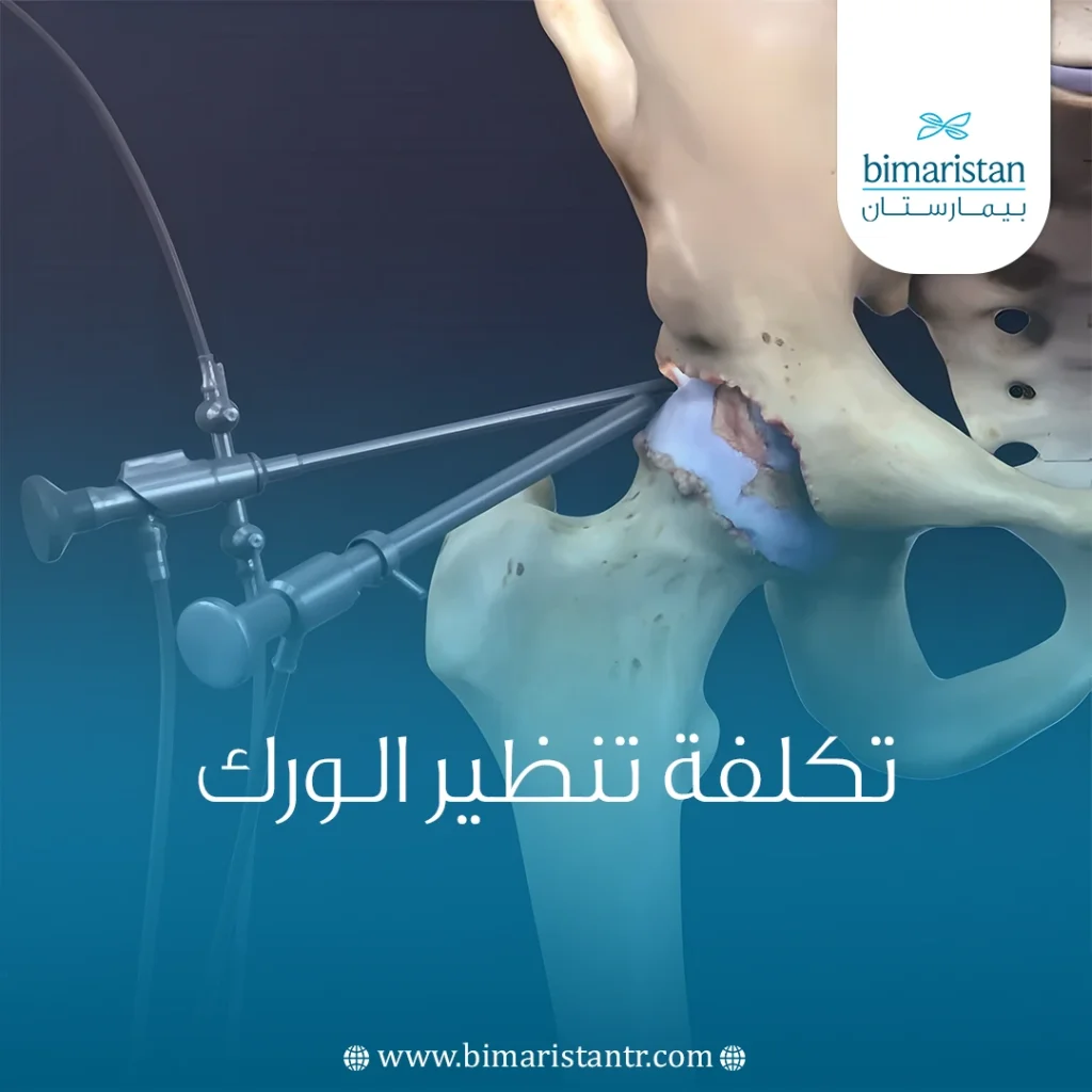 تكلفة تنظير الورك
