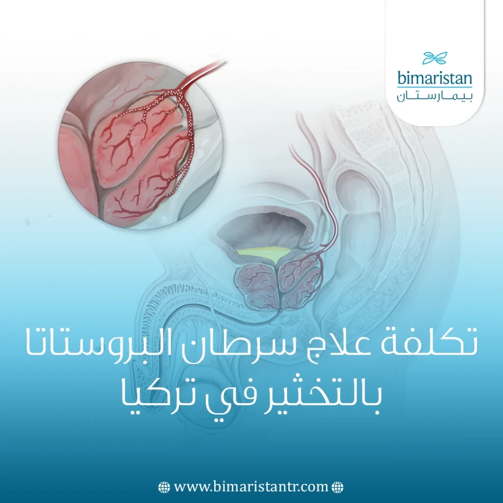 تكلفة علاج سرطان البروستاتا بالتخثير في تركيا